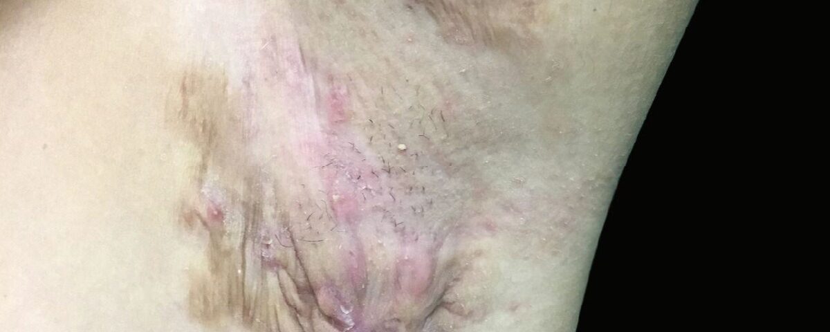 Hidradenite Supurativa tem cura?