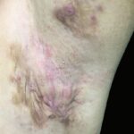 Hidradenite Supurativa tem cura?