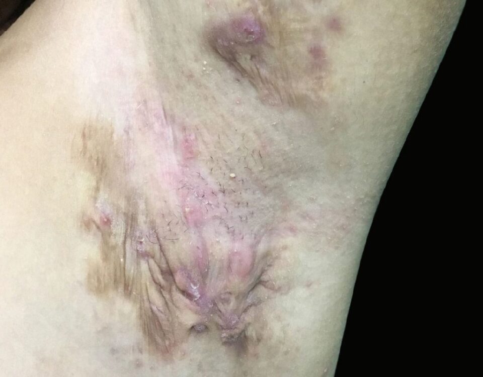 Hidradenite Supurativa tem cura?